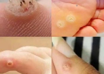 Seien Sie sehr vorsichtig: Wenn Sie dieses Wachstum auf Ihrer Haut bemerken, kann es ernst sein