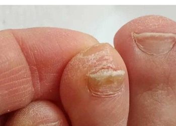 Der Trick zur Reduzierung der Zehennageldicke