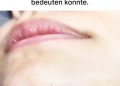 Kinnhaare bei Frauen: Was bedeutet das