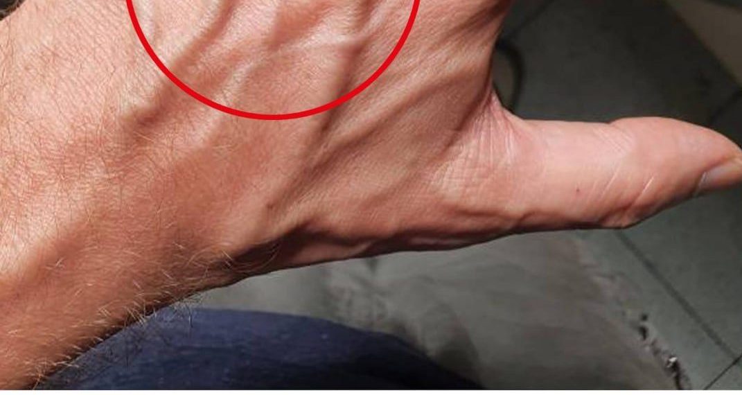 Wenn Sie sichtbare Venen haben, bedeutet das, dass Sie