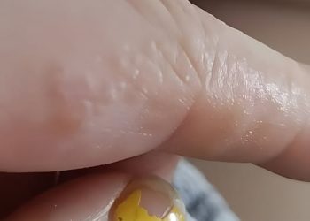 Das sind diese kleinen juckenden Beulen an deinen Fingern